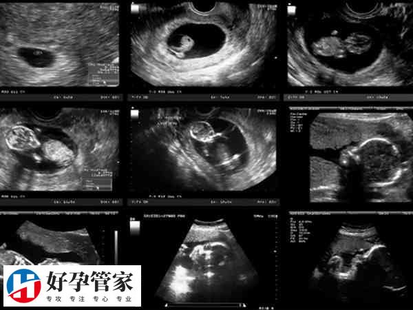 b超发现胎儿心室内强光点怎么办